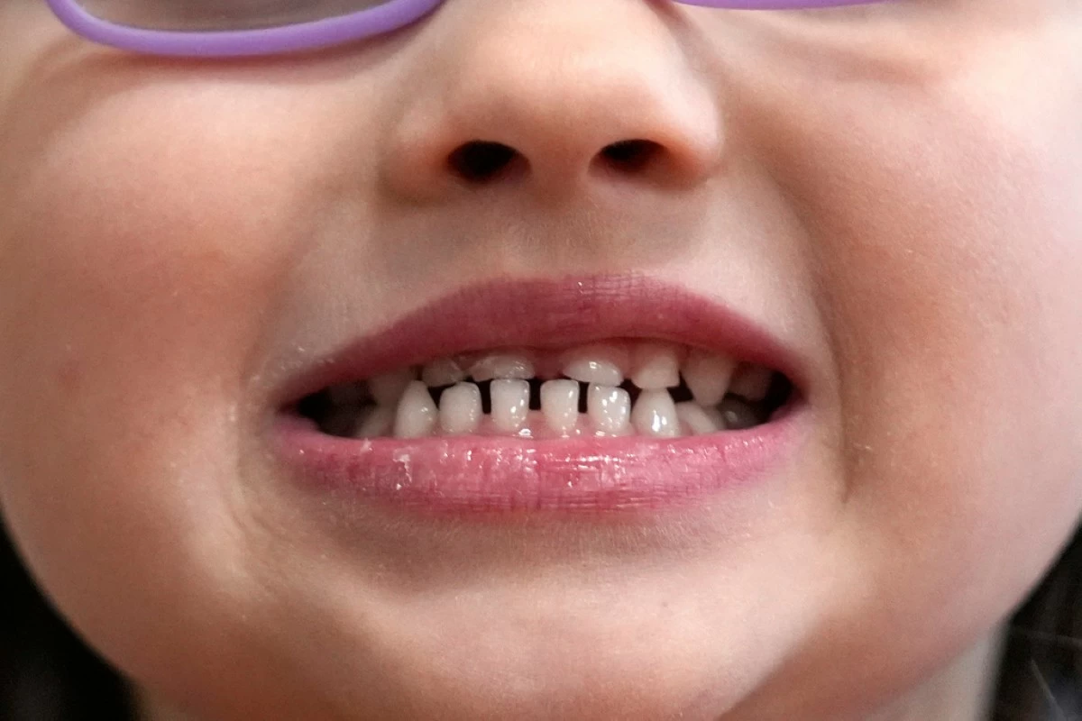 FILE - A child shows off her teeth after a dental exam in Concord, N.H., Wednesday, Feb. 21, 2024. (AP Photo/Robert F. Bukaty, file)