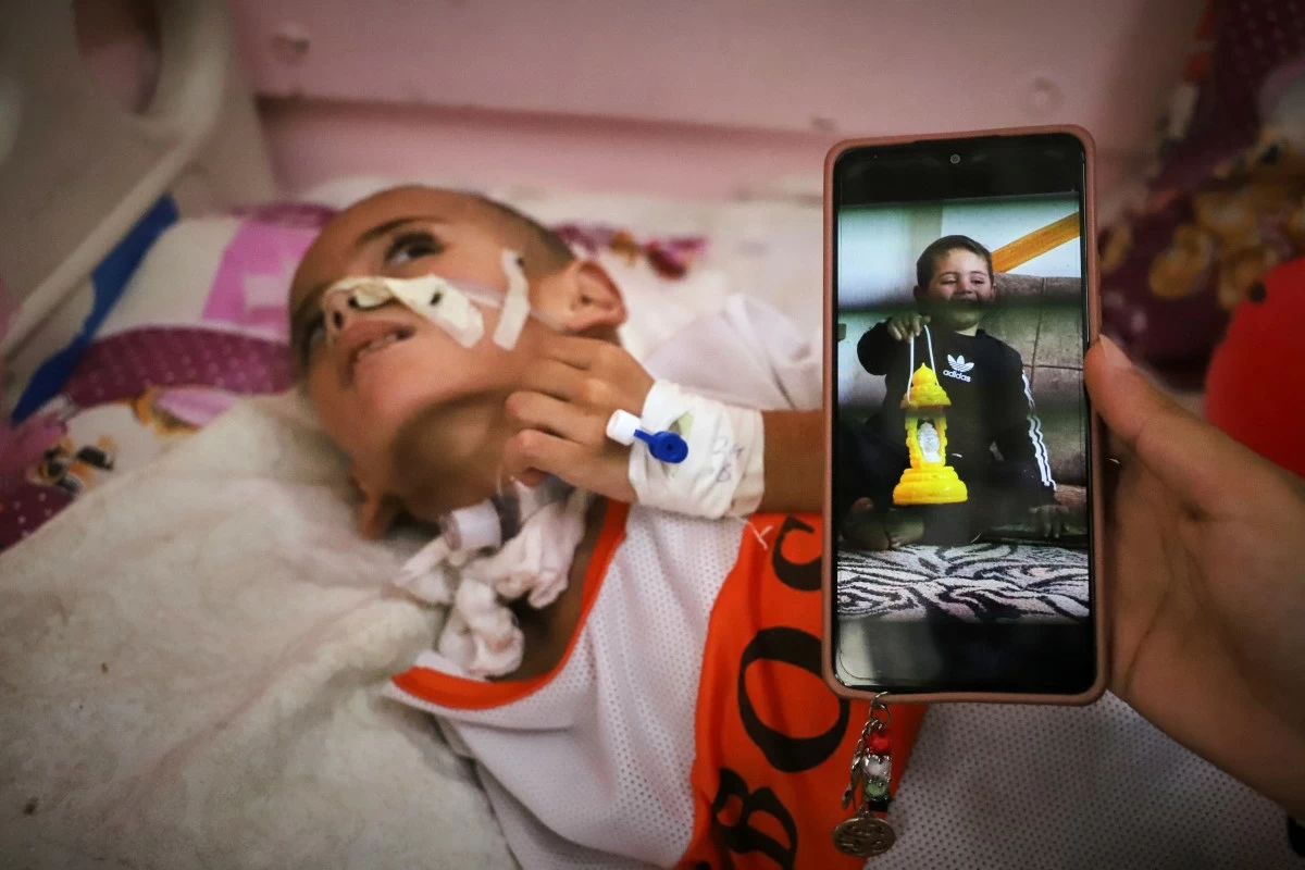 AN old photo of three-year-old Amr al-Hams is displayed on a phone as he lies in a hospital bed with brain damage caused by an Israeli strike on his family's tent in April at Nasser Hospital in Khan Younis, Gaza Strip, Wednesday, June 25, 2025. (AP)