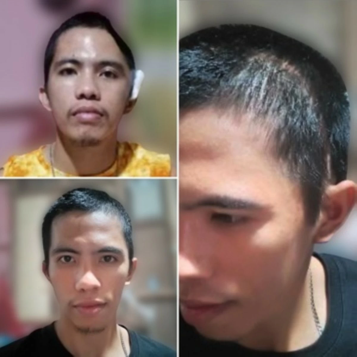 Before (upper left) and after (lower left and right) photos showing the successful outcome of the procedure.