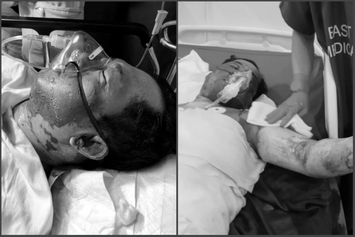 James Villaruel being treated for severe burns in a hospital (Photos from Bhabie Garmino's video) 