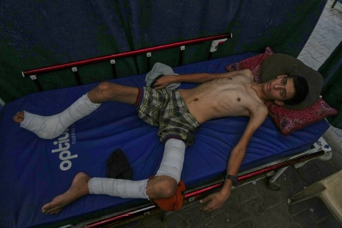 Ahmad Sbeteh, 17, injured by shrapnel from a strike on a neighboring house, has lost about 15 kilograms (33 pounds), and doctors say the lack of healthy food and nutritional supplements is slowing his recovery at Shifa Hospital in Gaza City on Monday, Aug. 18, 2025. Before the shrapnel injury, he had no preexisting conditions, doctors say. (AP Photo/Abdel Kareem Hana, File)