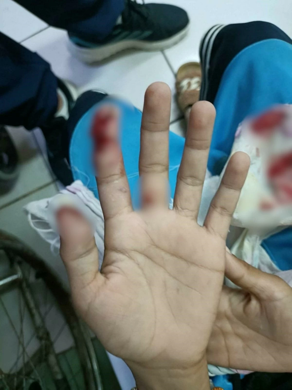 The injured finger of a boy in Muntinlupa (Photo from Mayor Ruffy Biazon's Facebook account) 