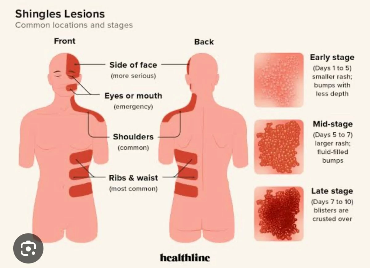 FROM THE HEALTHLINE website, a sobering graphic on shingles lesions - and why I was extra-worried as I read ‘emergency’.