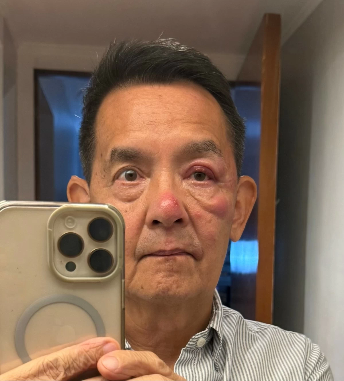 Shingle Bells! Shingle’s Hell! On my third day of Shingles.