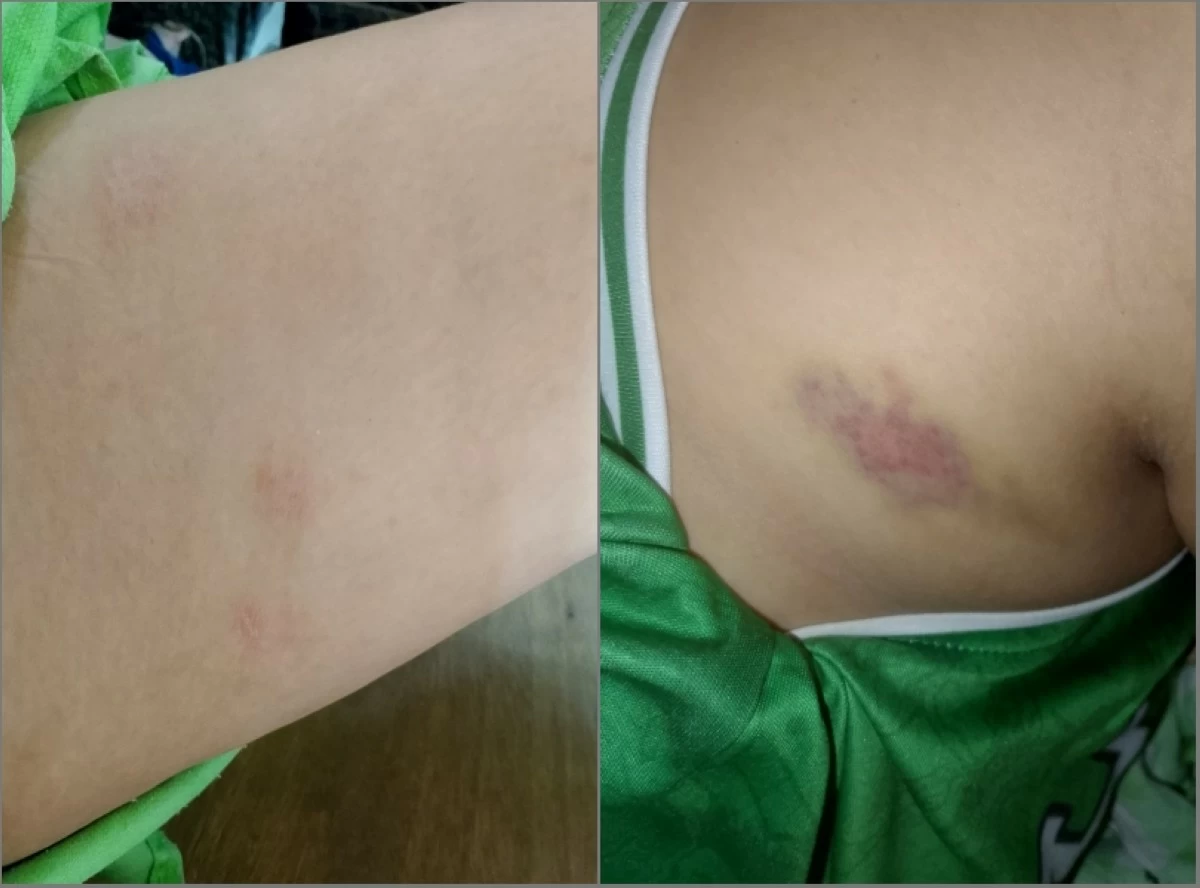Photos showing the mother's bruises (Photo from the Facebook account of the mother of the three-year-old child abuse victim) 