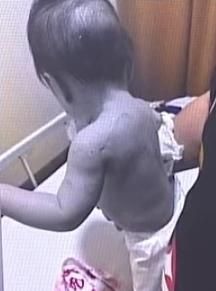 Baby poured with hot water in Bulacan.jpg