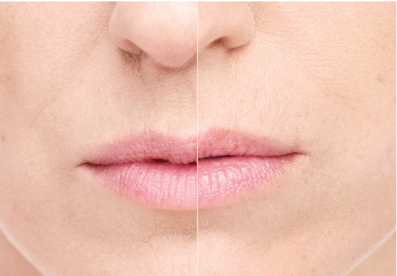 Belotero Balance.jpg