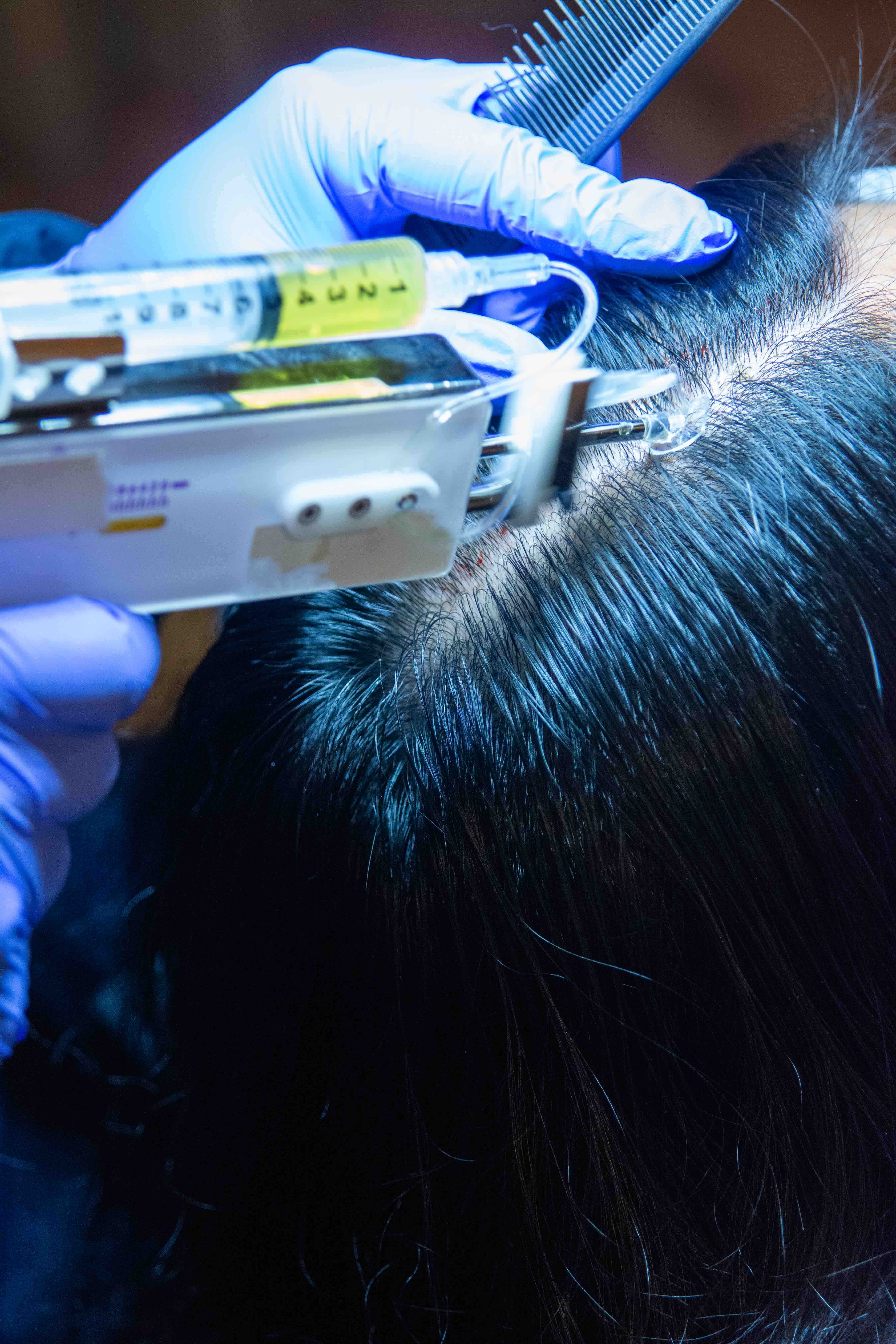 The writer's scalp on her thrid session.jpg